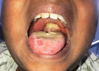 Diphtheria: Over 600 died of disease in 10 months - FG