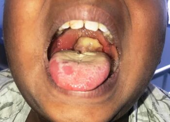 FCTA announces outbreak of Diphtheria in Abuja