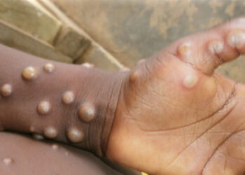 Mpox: All you need to know about the deadly virus